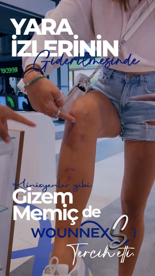 YARA İZLERİNİZE VEDA ETME ZAMANI👍🏻

@Gizemmemic 👉🏻yara izlerini geçirmek için bizi tercih etti. 
Siz de Wounnex'le yara izlerinizden kurtulabilirsiniz. 

Yara İzlerini Geçiren Jelimiz Hakkında 👉Detaylı için DM'den  iletişime geçebilirsiniz. 

#Wounnex 
#Yaraİzleritedavisi
#Yaraİzlerinasılgeçer #yaraizigeçirenkrem #yaraizi #yaraizikapatma #yaraizigeçirenkrem #yaraizi #yaraizikapatma #yaraizlerinintedavisi #Yaraİzlerineson